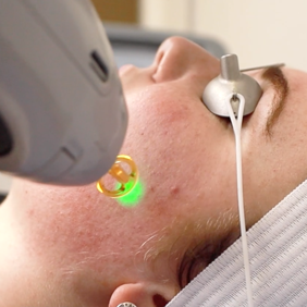 laser-resurfacing
